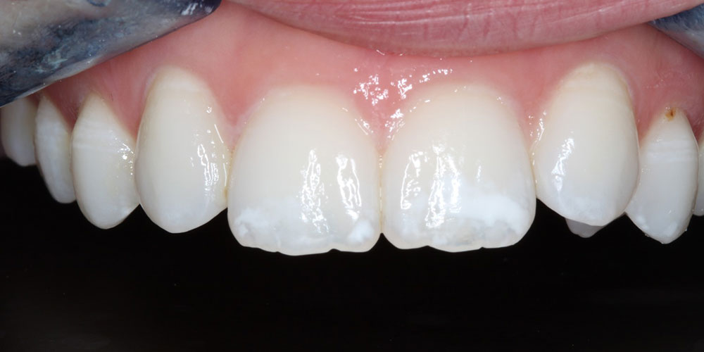 Cosmetic Bonding and Whitening After