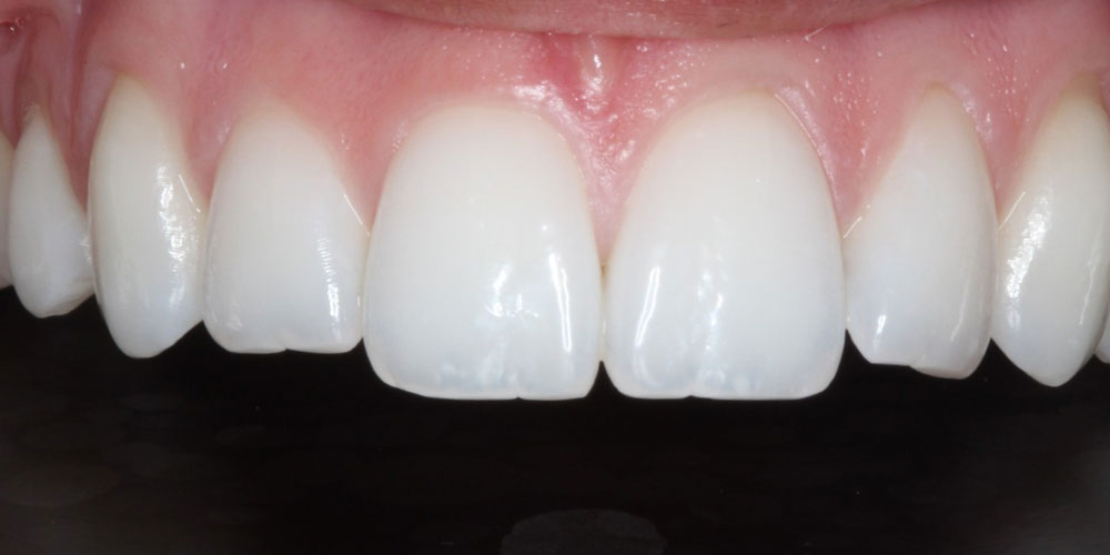 Cosmetic Bonding and Whitening After