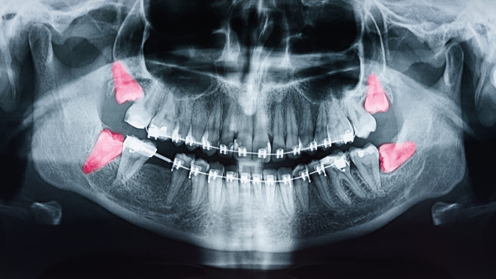 , What are wisdom teeth? And do I need to have them removed?