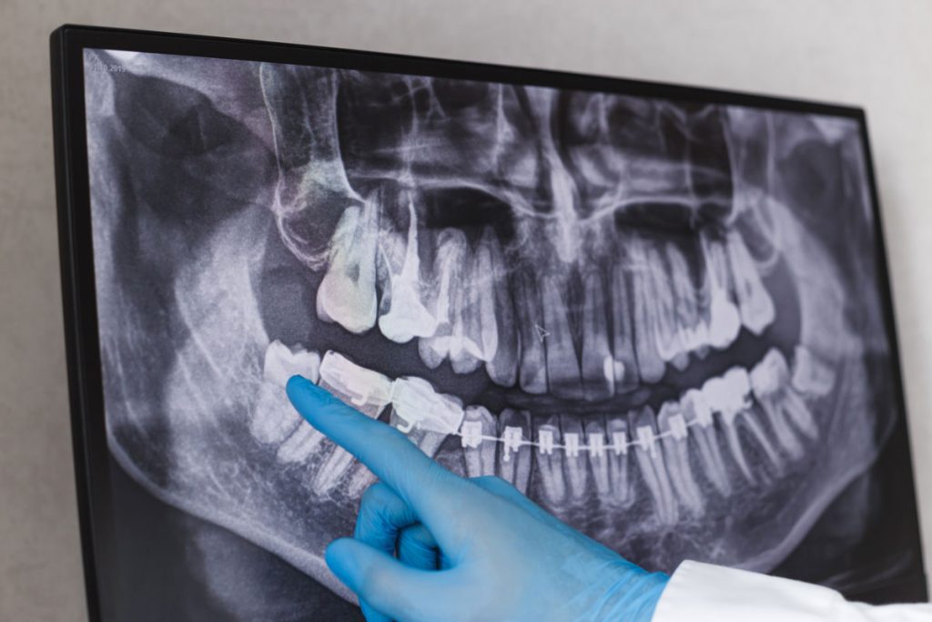 Wisdom tooth x-ray