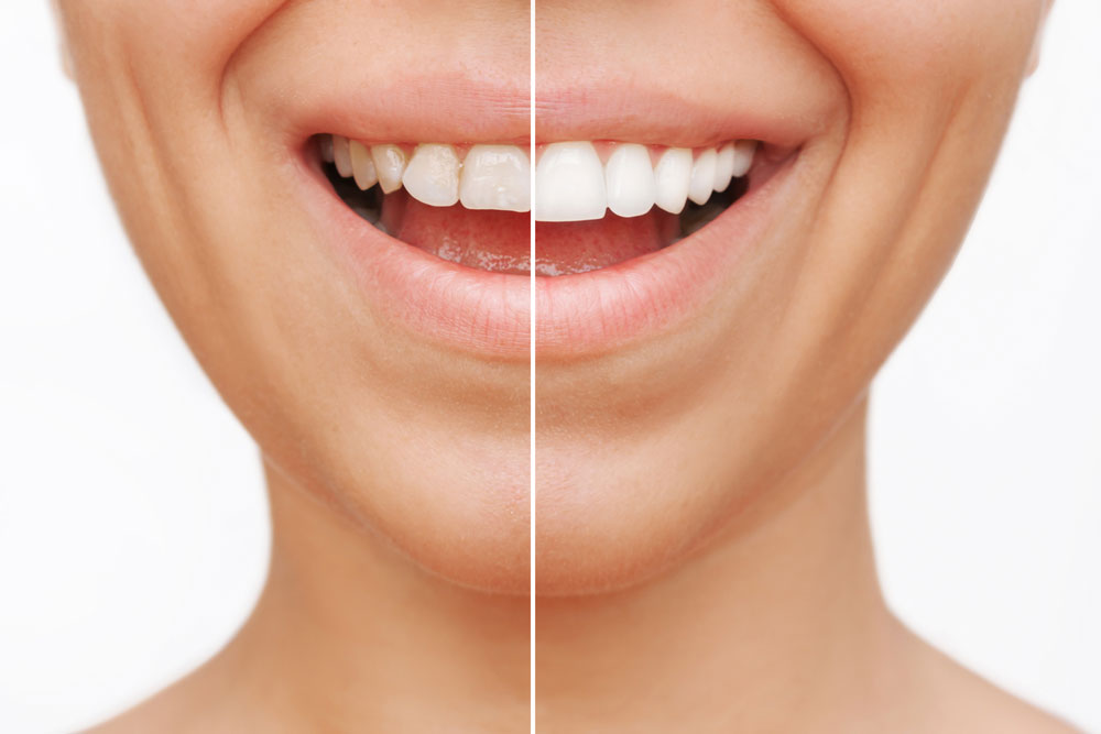 Dental veneers before and after